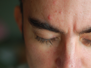 A acne pode ter um impacto maior na qualidade de vida das pessoas do que muitas outras doenças Foto: Derek K. Miller/Flickr