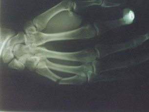Bonelike pode ser aplicado numa zona de fractura ou defeito ósseos Foto: Morguefile