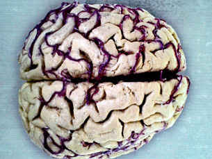 Imagens tridimensionais do cérebro indicam quais as zonas com menor fluxo sanguíneo Foto: giulia.forsythe/Flickr