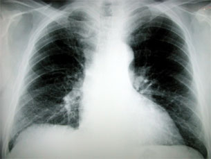 Globalmente, a ameaça da tuberculose continua a aumentar Foto: Arquivo JPN